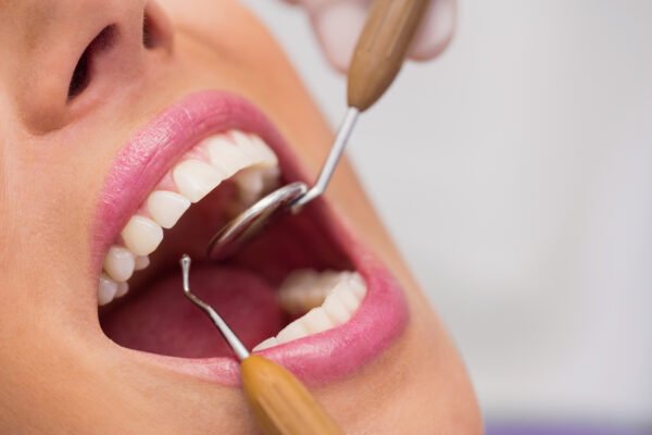Limpieza Dental Profesional